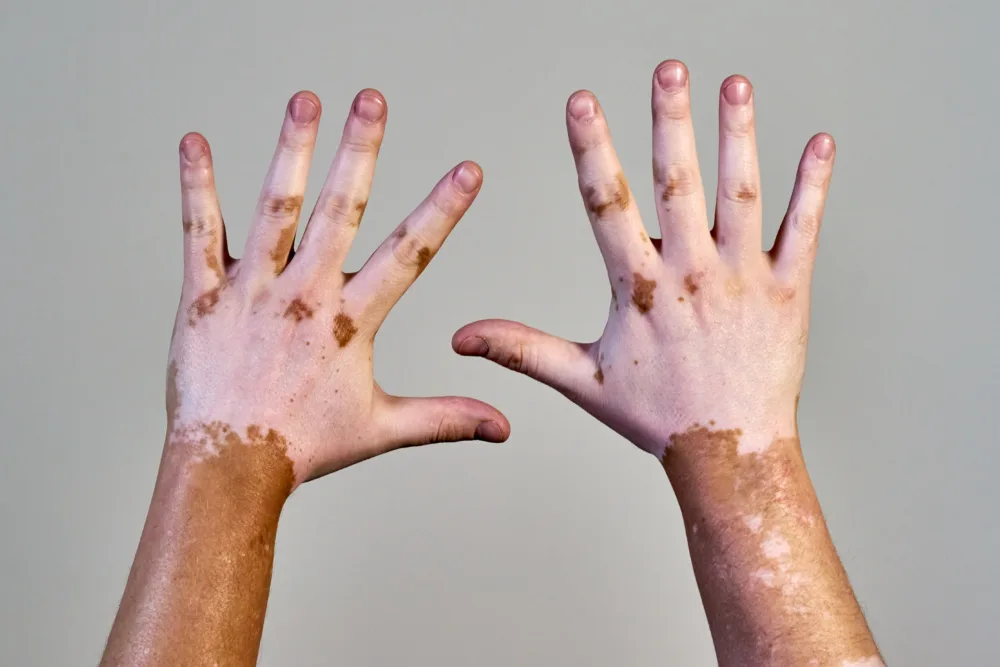 Guardoli Dermatology Nice • Des résultats tout au long de la procédure