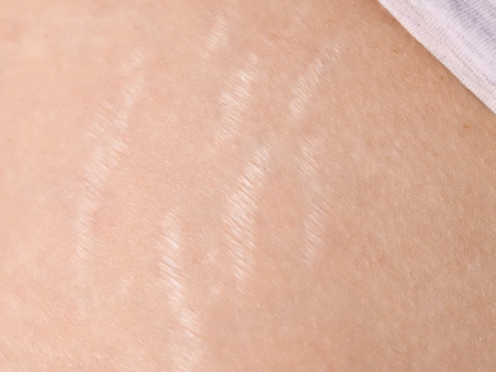Guardoli Dermatology Nice • Vergetures