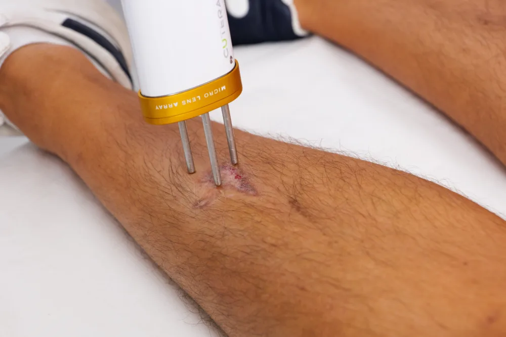 Guardoli Dermatology Nice • Cicatrices post-chirurgicales/post-traumatiques
