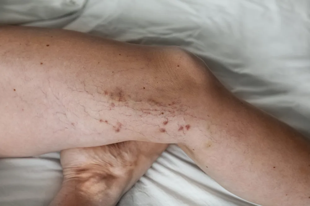 Guardoli Dermatology Nice • Jambes, zone la plus fréquemment concernée