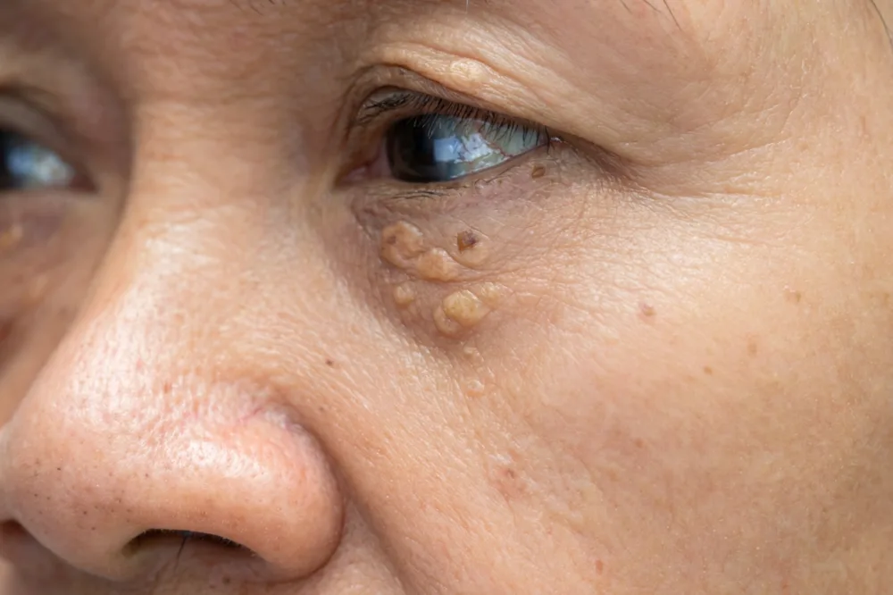 Guardoli Dermatology Nice • Paupières, zone fine sensible aux dépôts lipidiques