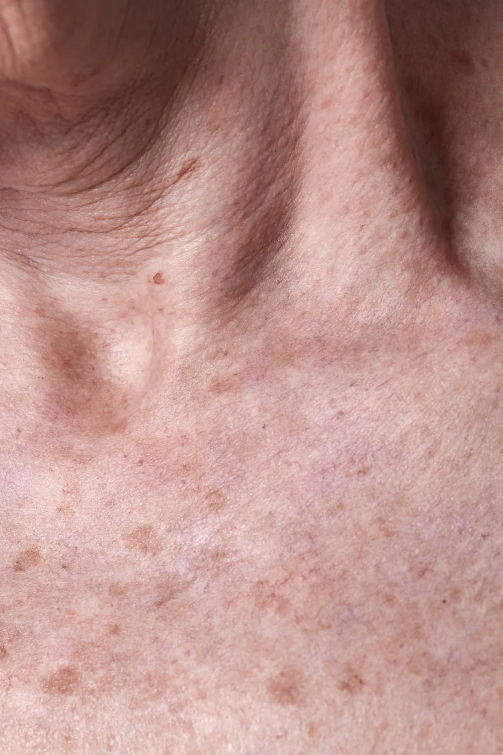 Guardoli Dermatology Nice • Décolleté