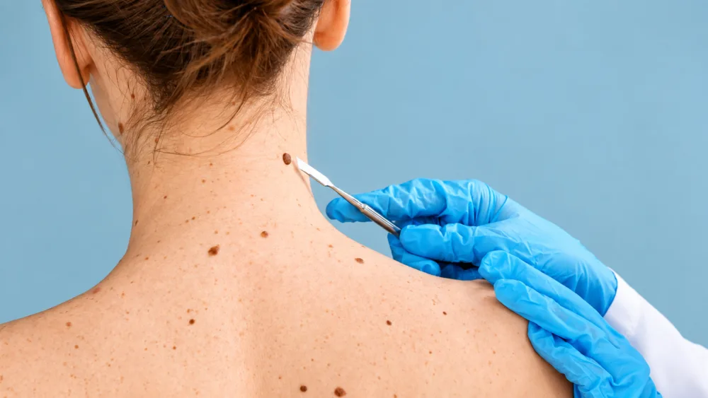 Guardoli Dermatology Nice • Corps, selon la localisation du nævus dermique