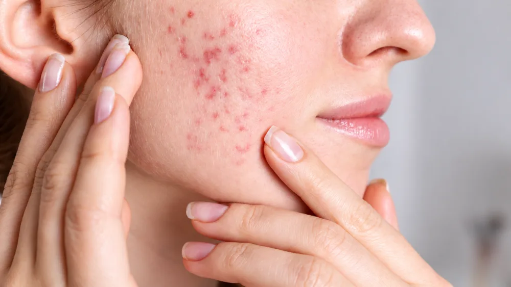 Guardoli Dermatology Nice • Cicatrices d'acné du visage