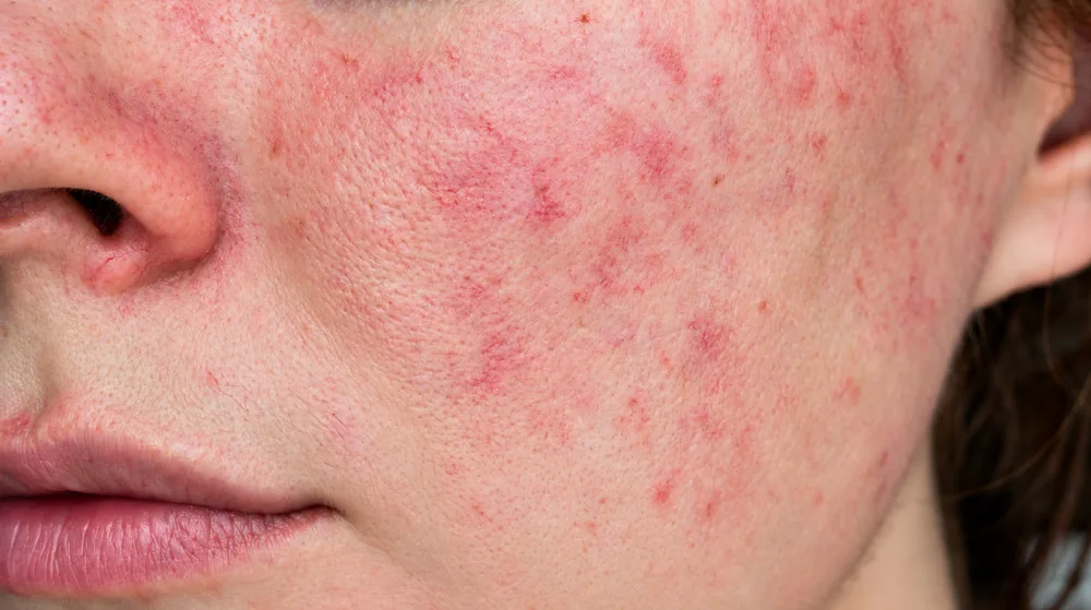 Guardoli Dermatology Nice • Joues
