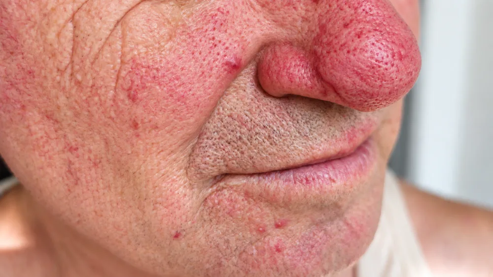 Guardoli Dermatology Nice • Joues