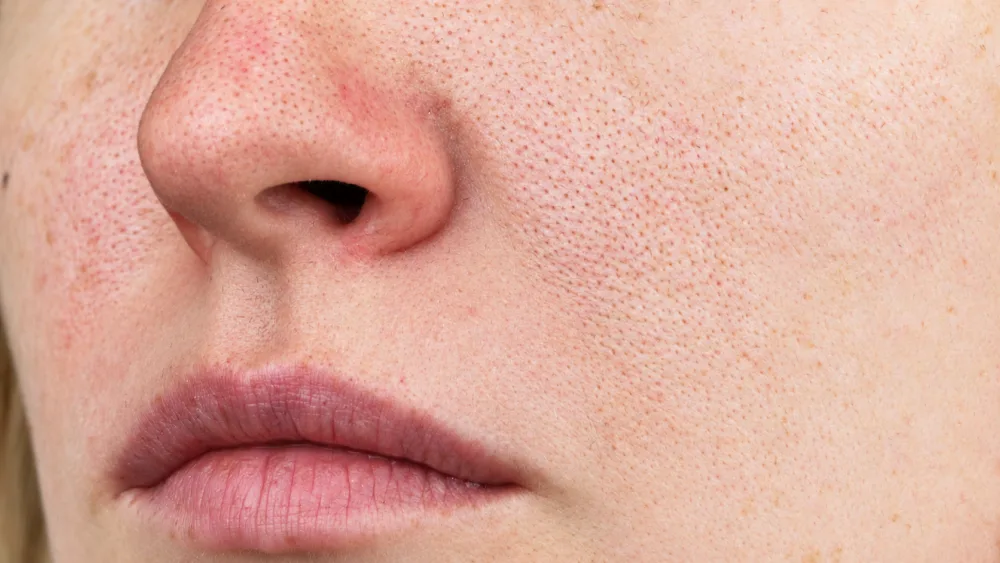 Guardoli Dermatology Nice • Nez